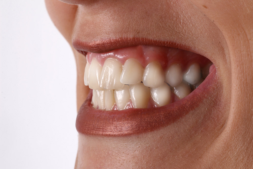 rencontres avec dentiers partiels site de rencontre dans l’état d’Ondo